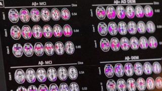 数十万元阿尔茨海默病疗法纳入首版商保创新药目录，离进医保还远吗